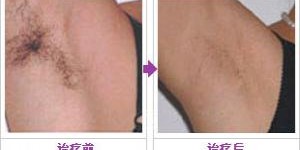 狐臭手术费用大概是多少？了解具体价格，是否值得尝试？