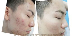苗誉堂祛痘费用是多少？一针价格又是多少？